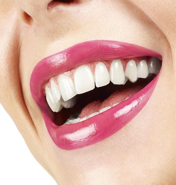 Cosmetic dental bonding procedure