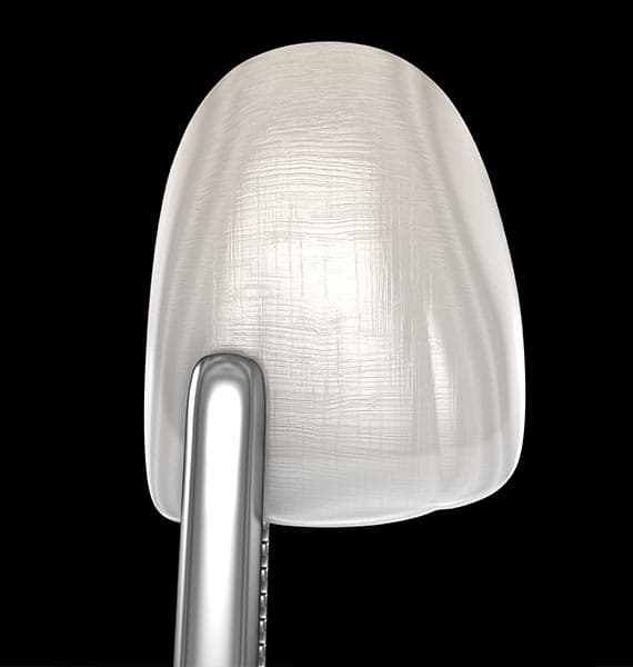 Porcelain veneers treatment